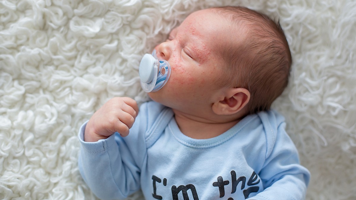 newborn baby's face with red rash acne and pimples